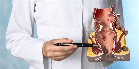 Top 10 Myths And Facts Of Anal Fissure