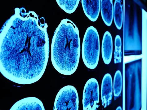 Enfermedad De Huntington Claves Para Conocerla Salud Hoy