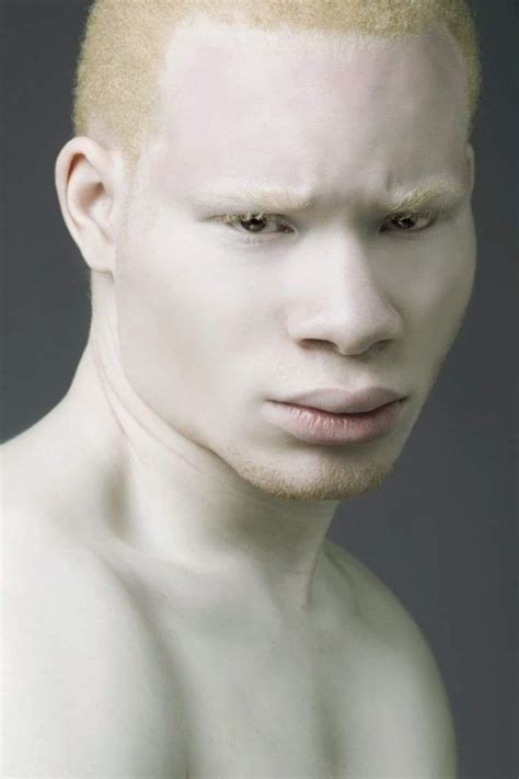 How much percentage of albinism do pale skinned people have? - Quora