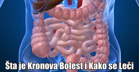 Kronova bolest creva simptomi ishrana lečenje