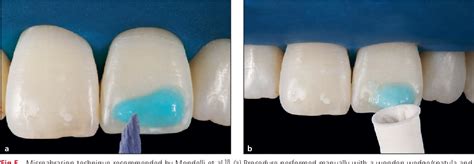 Figure 1 From Dental Bleaching Microabrasion And Resin Infiltration