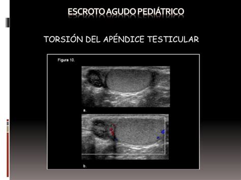 Escroto agudo en pediatría PPT