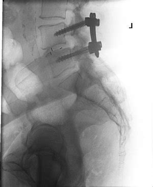 Mustafa Khan MD Complex Minimally Invasive Spine Surgery Milwaukee