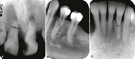 Tooth Fracture Xray