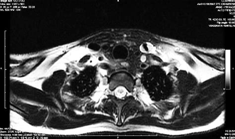 T2fatsat Pathologic Valve Stenosis In The Junction Of The Left Ijv Download Scientific Diagram