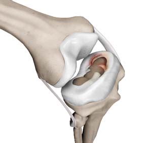 Meniscal Injuries Adelaide Henley Beach Meniscal Surgery North