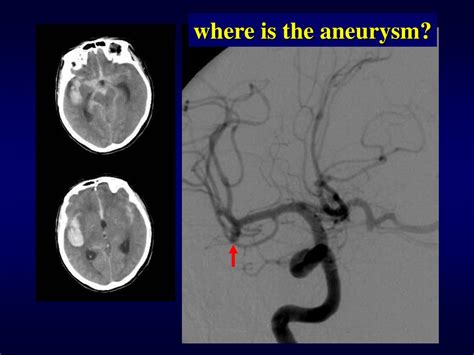 Ppt Cerebral Aneurysms Powerpoint Presentation Free Download Id 154737