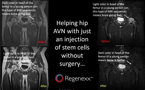 Hip AVN Surgery Alternative Another Hip AVN Patient Treated With Stem