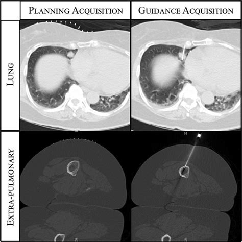 Lung nodule biopsy with low dose CT guidance protocol. Single images... | Download Scientific ...