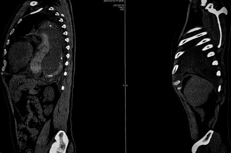 Computer Tomography Angiography Cta Of Whole Body Scan With 3d Reconstruction Ct Angiography For