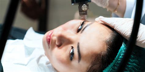 Everything You Need To Know About Radiofrequency Microneedling