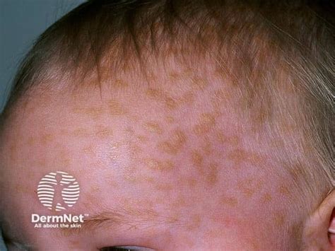 Cutaneous Mastocytosis Images — Dermnet