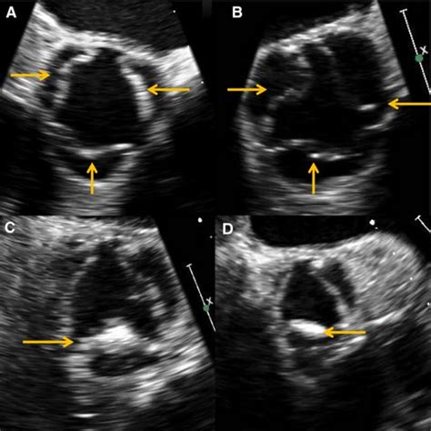 Patterns of aortic sclerosis seen on echocardiography. Diffuse (A) and... | Download Scientific ...