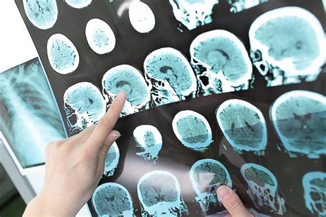 Alzheimer Fases S Ntomas Y Tecnolog As Claves Para Su Manejo Viu Espa A