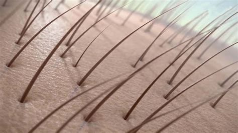 Causes Of Hair Loss Hermest Clinic Hermest Clinic