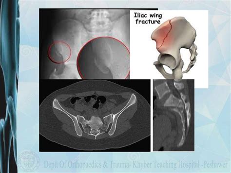 Classification Of Pelvic Fracture