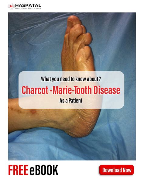 How Charcot Marie Tooth Disease Can Affect Your Health Haspatal Online