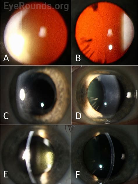 Fuchs Endothelial Corneal Dystrophy