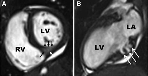 Prevalence And Clinical Profile Of Myocardial Crypts In Hypertrophic