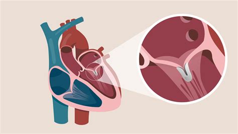 Mitral Valve Repair And Replacement