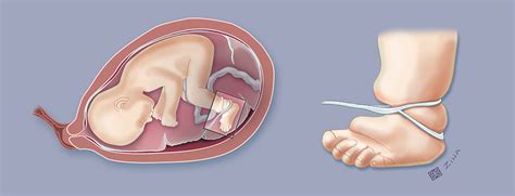 Amniotic Band Syndrome Fetal Care And Treatment Center Uc Davis