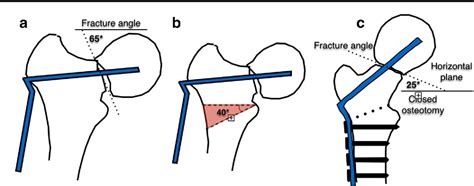 Valgus intertrochanteric osteotomy for femur neck pseudoarthrosis: a simple solution to a ...