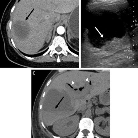 Hemorrhage Of A Renal Cyst A Baseline Axial T Weighted Mri In An