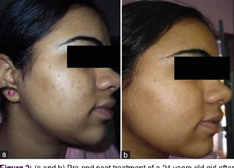 Figure 2 From Platelet Rich Plasma In Dermatology And Aesthetic