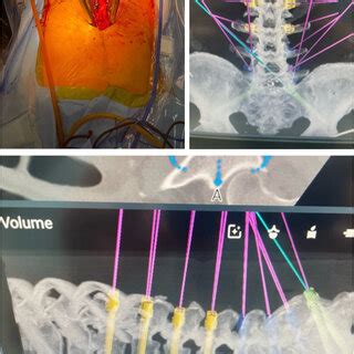 Intraoperative Robotics Planning Of Pedicle Screw Placement And Use Of