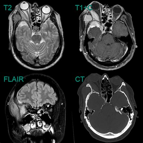 Meningioma Neuroradiology