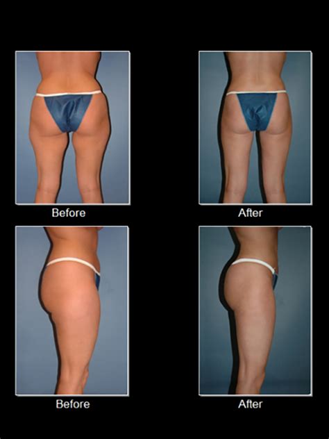 Liposuction And Buttock Fat Grafting Before After Photos Lansing