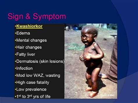 Kwashiorkor Children