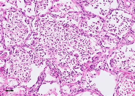 Atypical Pneumonia Histology