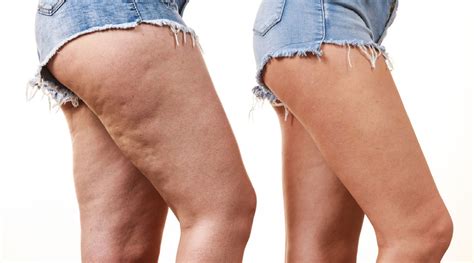 Lipedema Qué Es Síntomas Causas Y Nuevos Tratamientos vlr eng br