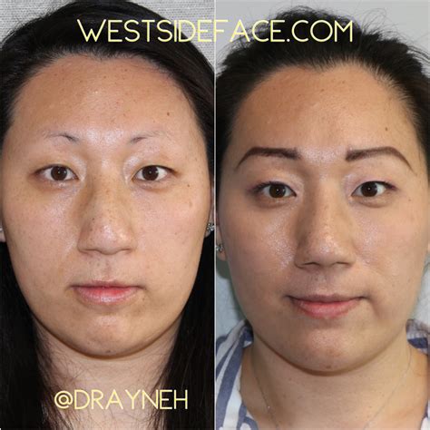 Closed Scarless Ethnic Rhinoplasty And Crooked Nose Repair Westside Face