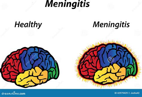 Meningitis Stock Vector Illustration Of Disorder Meningococcal 42979429