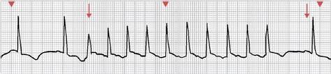 Ventricular Dysrhythmias Flashcards Quizlet