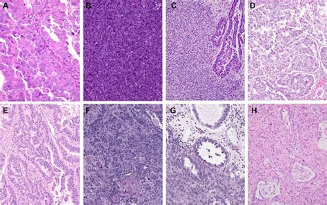 Histopathologic Features And Molecular Genetic Landscape Of HER2