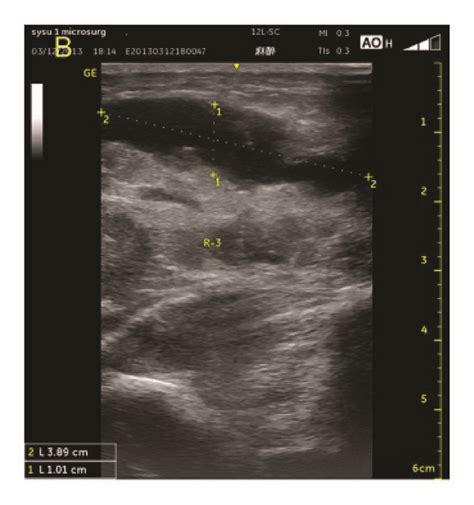 Ultrasound Classification Criteria For Muscle Injury—a Case With A Download Scientific Diagram