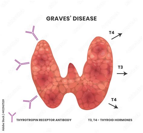 Graves Disease Diagram