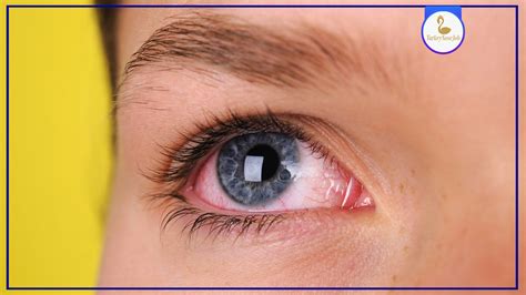 Eye Redness: Causes, Symptoms, and Treatment Options - Turkeynosejob ...