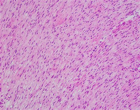 Pathology Outlines Fibromatosis Palmar Plantar