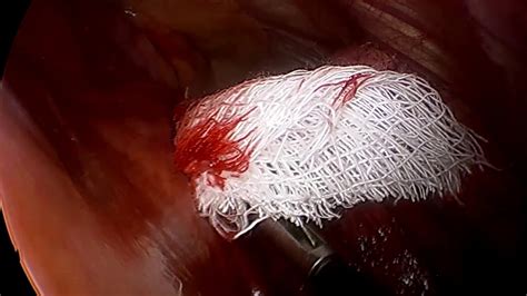 Biópsia de linfonodo na janela aortopulmonar por VATS YouTube