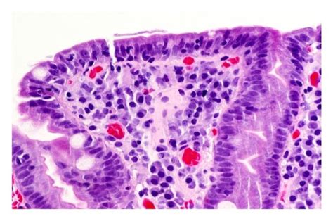 A Biopsy Of The Duodenum Reveals Villous Blunting And Expansion Of