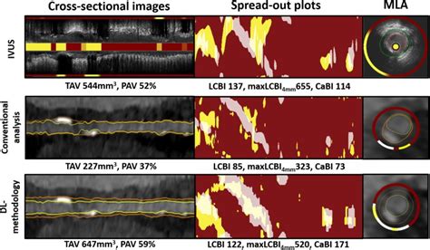 Novel Near Infrared Spectroscopyintravascular Ultrasound Based Deep