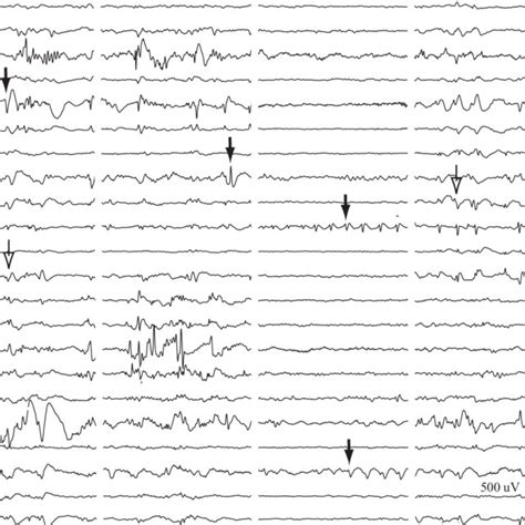 Patient 6 Ictal SEEG Recording Focal Electrographic Seizure Onset In