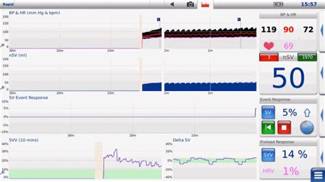 Hemodynamic Monitor Screen Video LiDCO Hemodynamic Monitoring For