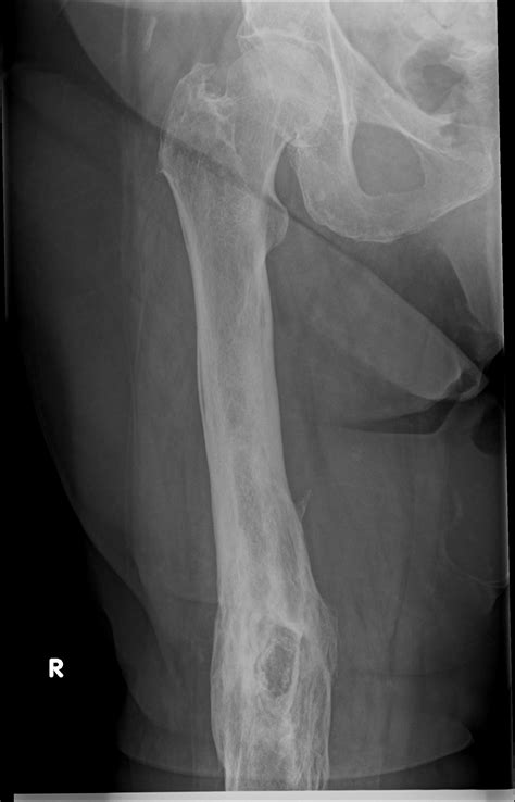 Chronic Osteomyelitis With Sequestrum Image