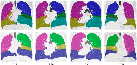 Figure 8 From Lung Lobe Segmentation Based On Lung Fissure Surface Classification Using A Point