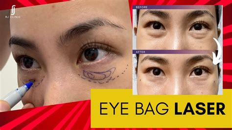 Non Surgical Eye Bag Laser Treatment Say Goodbye To Under Eye Bags